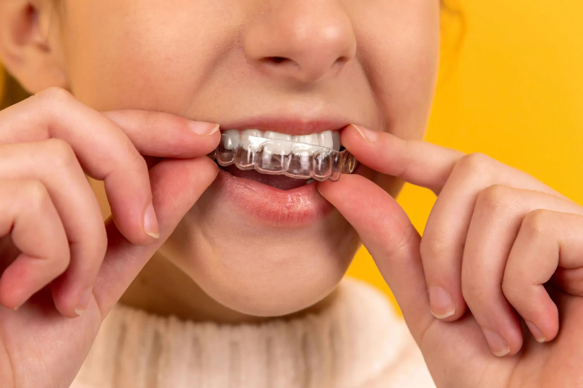 A patient placing a clear orthodontic aligner